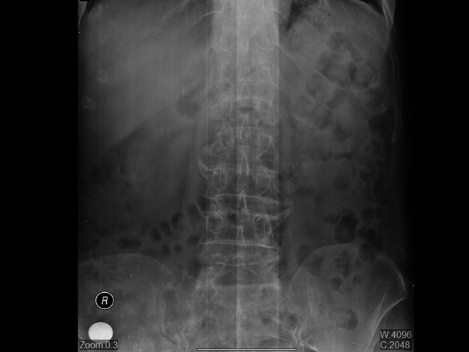 КЦ Бањалука: оперативни захват perkutana vertebroplastika - Фото: СРНА