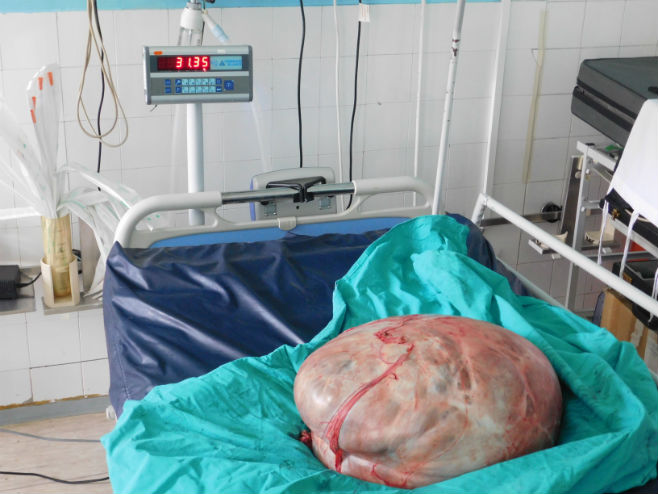 Operacija tumora teškog 31 kg (foto: RTRS)