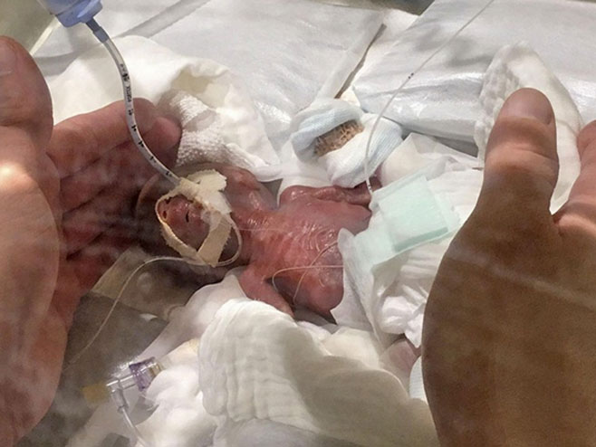 Најмања беба на свијету (Фото:Keio University Hospital) - 