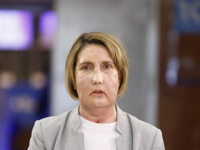 У Барселони изведена пионирска трансплантација лица (ВИДЕО)